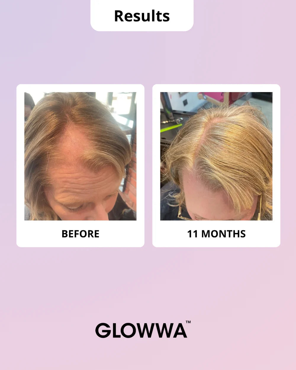Glowwa Hair Food Meno results – reduces hair loss during menopause